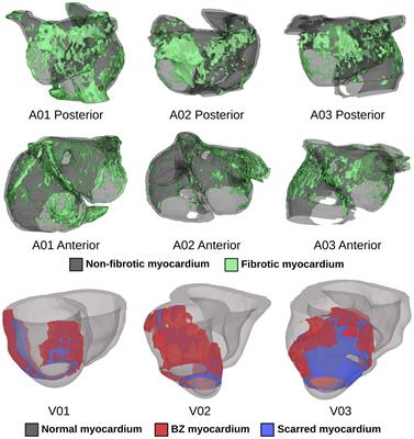 Optogenetic Stimulation Using Anion Channelrhodopsin (GtACR1) Facilitates Termination of Reentrant Arrhythmias With Low Light Energy Requirements: A Computational Study